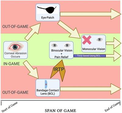 Bandage contact lens for in-game corneal abrasion can allow immediate return to play